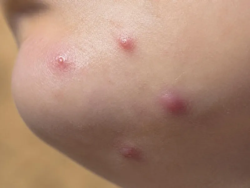 Piel de la mandíbula con granos rojos.