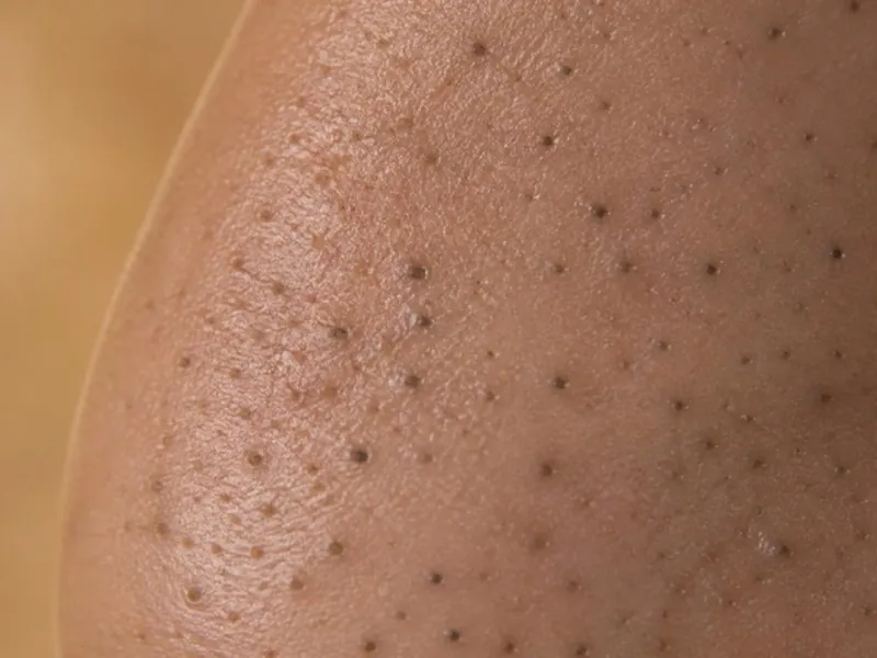 Piel de la nariz con puntos negros.